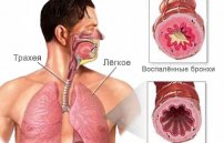 Лечение бронхита народными средствами в домашних условиях у взрослых