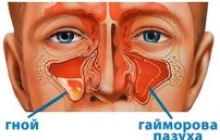 Гнойный гайморит: симптомы и лечение