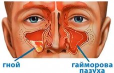 Гнойный гайморит: симптомы и лечение