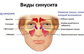 Синусит у взрослых: симптомы и лечение в домашних условиях