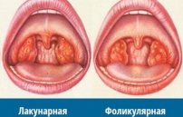 Фолликулярная ангина: лечение и фото у взрослых