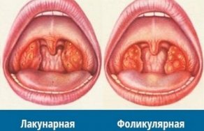Фолликулярная ангина: лечение и фото у взрослых