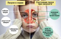 Синусит: лечение, симптомы и признаки болезни