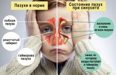 Синусит: лечение, симптомы и признаки болезни