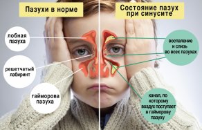Синусит: лечение, симптомы и признаки болезни
