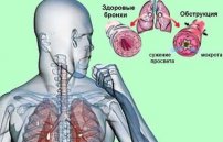 Обструктивный бронхит у взрослых: симптомы и лечение