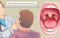 Воспаление миндалин: симптомы и лечение воспаленных гланд