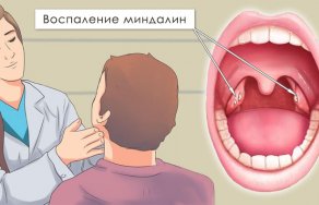 Воспаление миндалин: симптомы и лечение воспаленных гланд