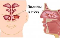 Полипозный гайморит: полипы гайморовой пазухи