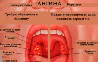Как выглядит ангина: фото больного воспаленного горла