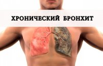 Как вылечить хронический бронхит навсегда: можно ли избавиться?
