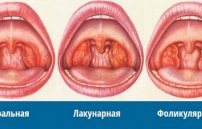 Виды ангины: какие бывают разновидности тонзиллита у взрослых
