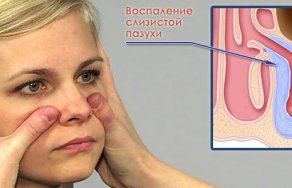 Воспаление гайморовых пазух: симптомы и лечение