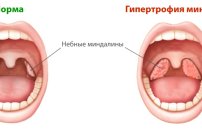 Гипертрофия миндалин: степени и лечение гипертрофированных аденоид