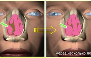 Что такое гиперпластический ринит: симптомы и лечение