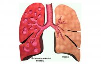 Бронхоэктатическая болезнь: симптомы и лечение легких