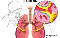 Лечение грудного кашля: как лечить боль и мокроту в груди