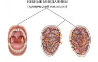 Можно ли вылечить хронический тонзиллит раз и навсегда