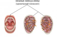 Можно ли вылечить хронический тонзиллит раз и навсегда