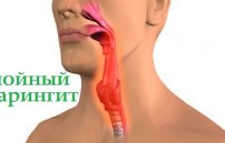 Гнойный фарингит: симптомы, лечение и фото у взрослых